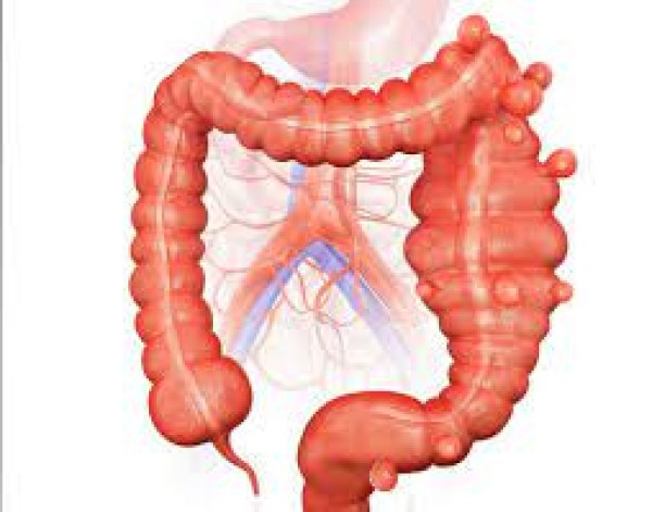 Imagem da especialidade: Diverticulose